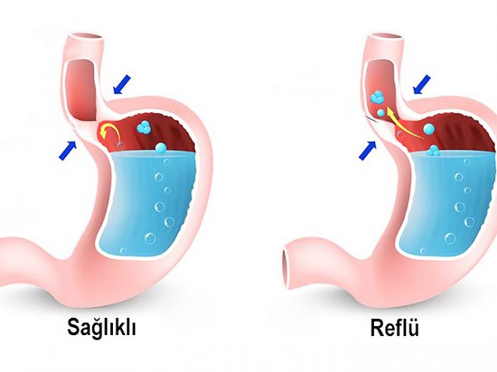 reflü hastalığı nedir