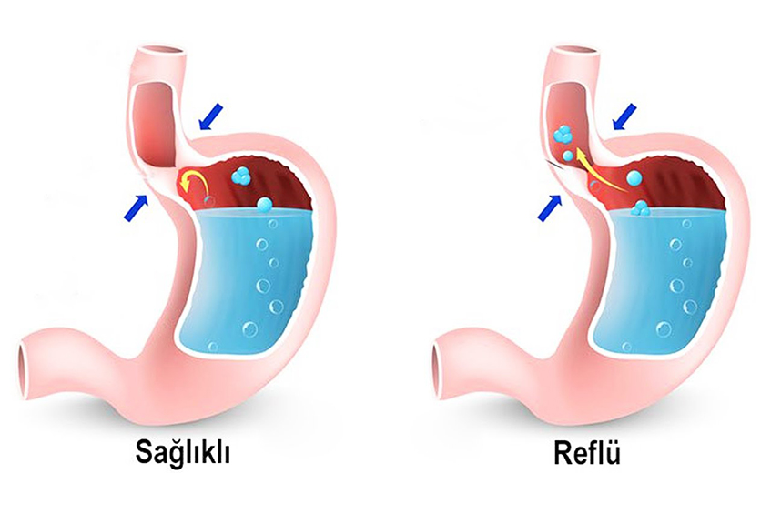 reflü hastalığı nedir